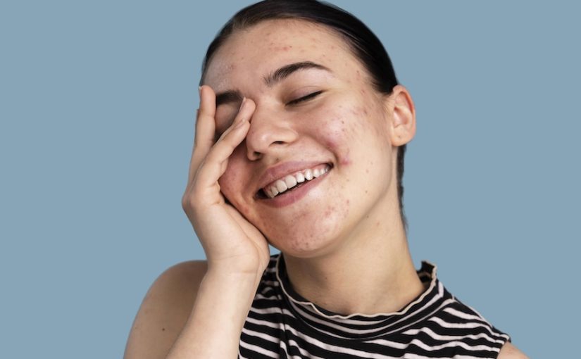 Trattamento acne Cuneo